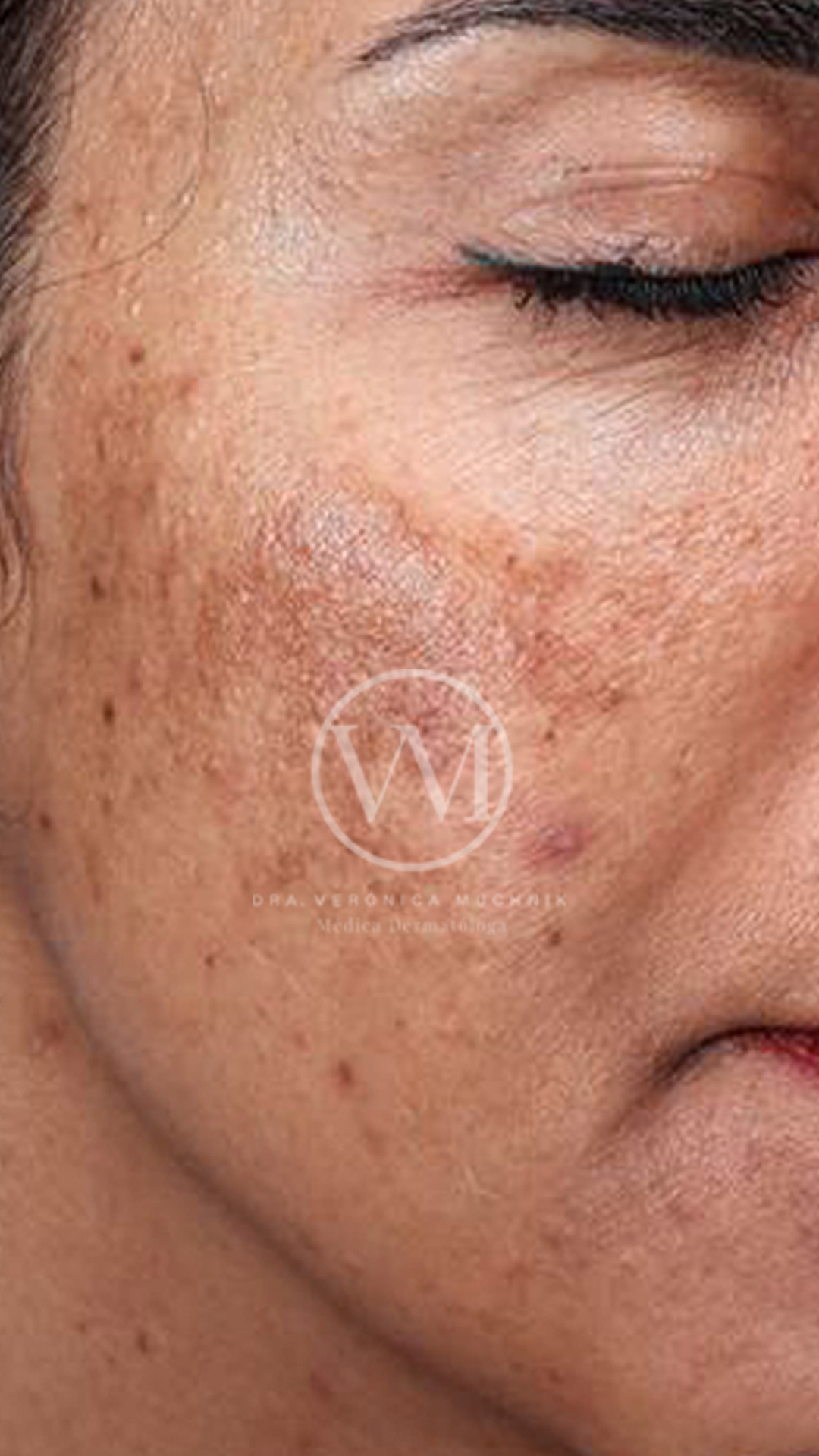 Melasma - caso clínico 1