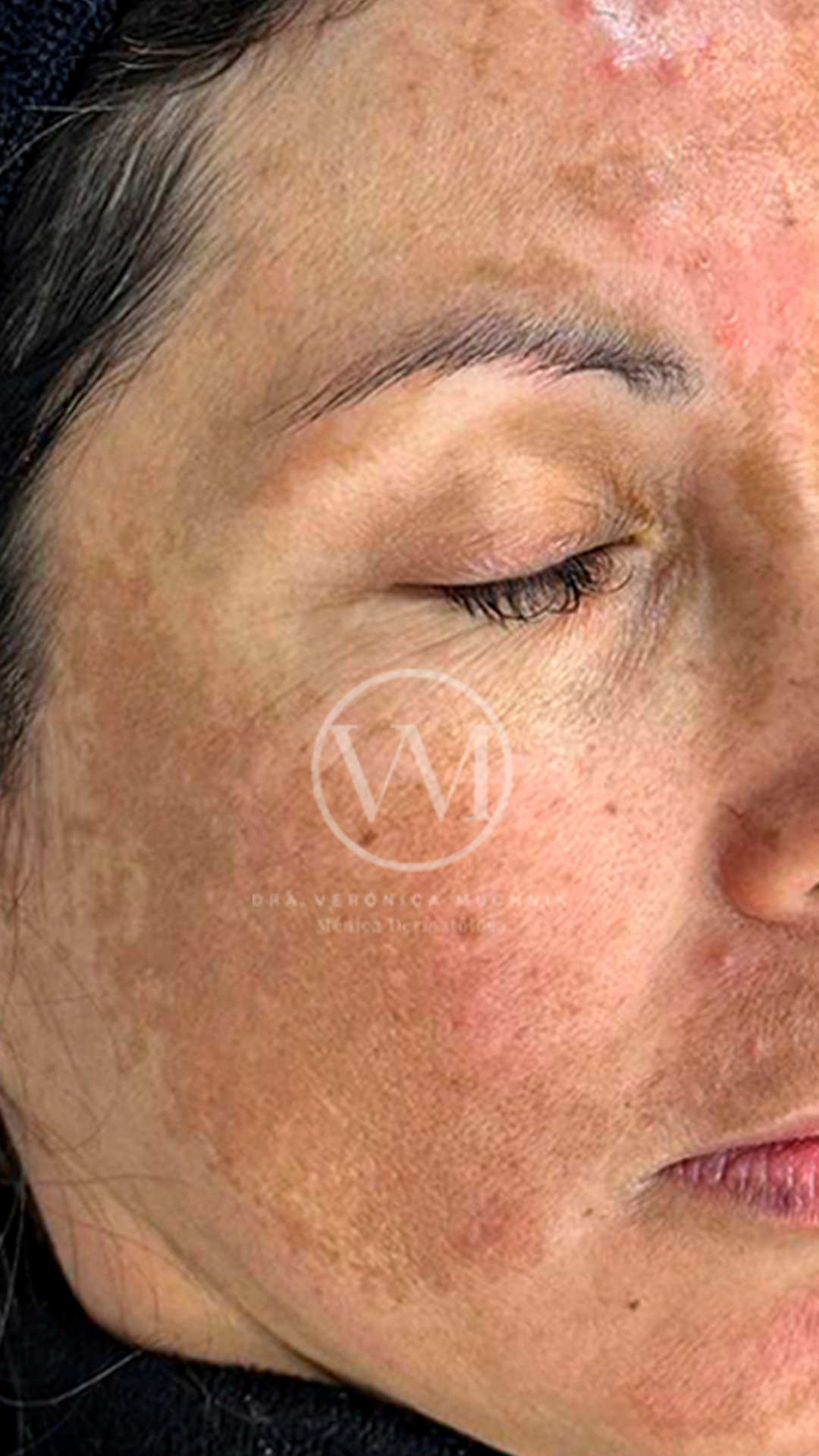 Melasma - caso clínico 2