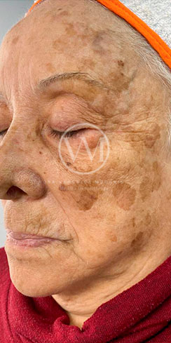 Rejuvenecimiento - caso clínico 1