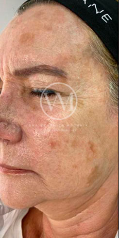 Rejuvenecimiento - caso clínico 2