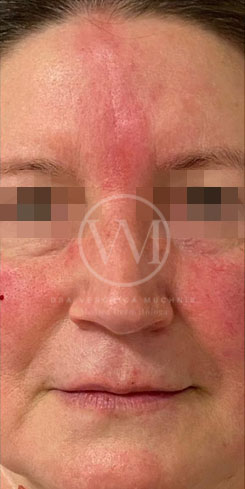 Rosácea - caso clínico